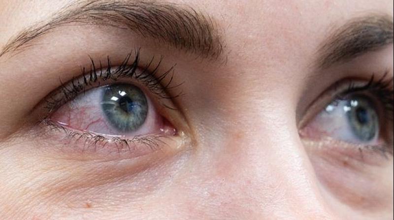 Pink eyes may be the primary symptom of covid-19: a study Pink eyes may be the primary symptom of covid-19: a study