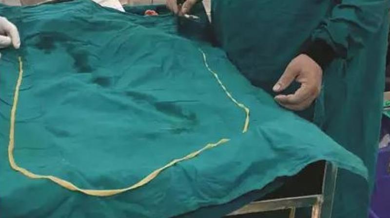 Kaithal alive insect of 6.3 feet long removed from the patients intestine Kaithal alive insect of 6.3 feet long removed from the patients intestine