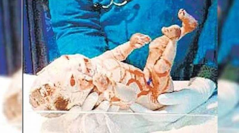 Plastic Child Born In Uttar Pradesh