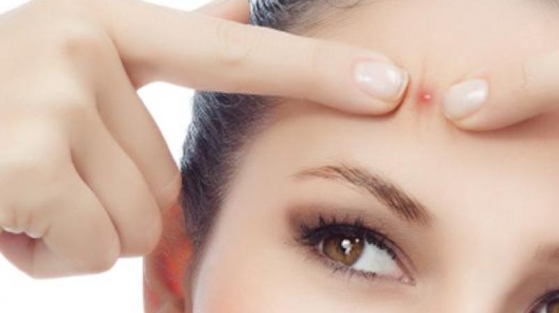 easy tips to get rid of pimples