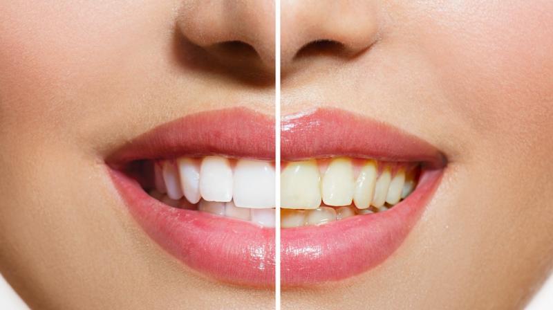  Yellowness of teeth is removed with coconut oil