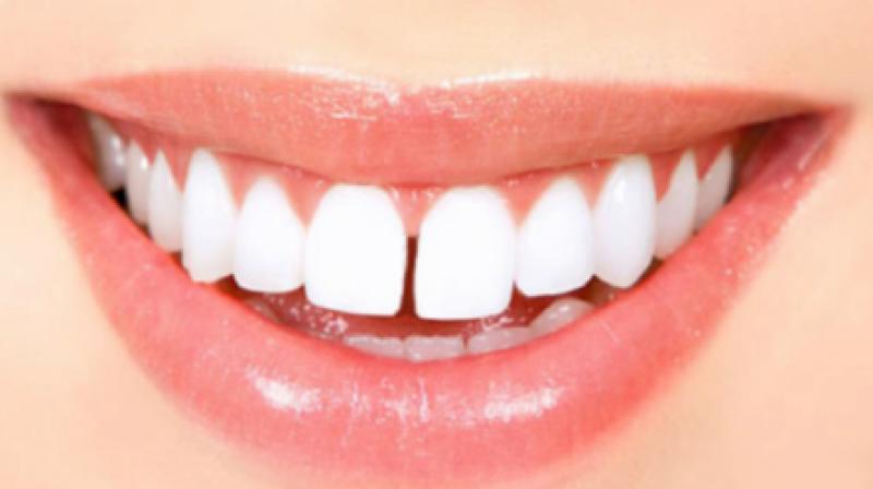 Diastema