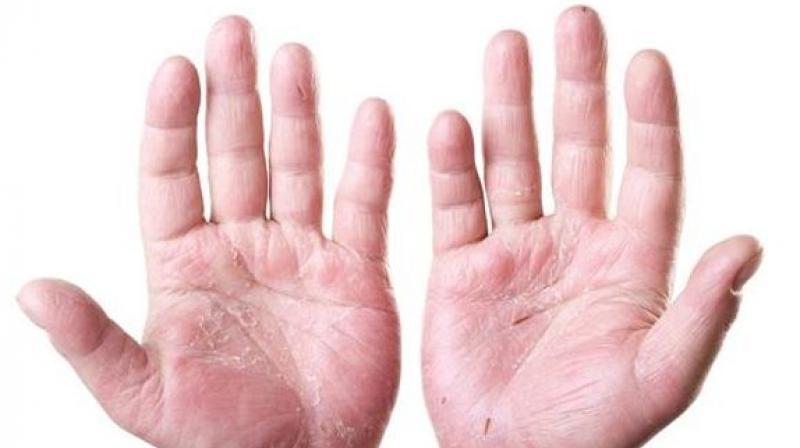 Psoriasis Psoriasis