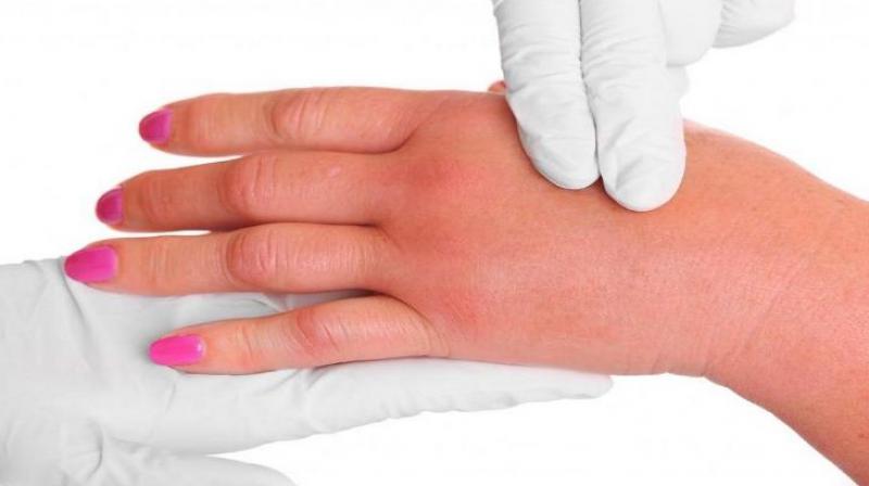 hand Swelling hand Swelling