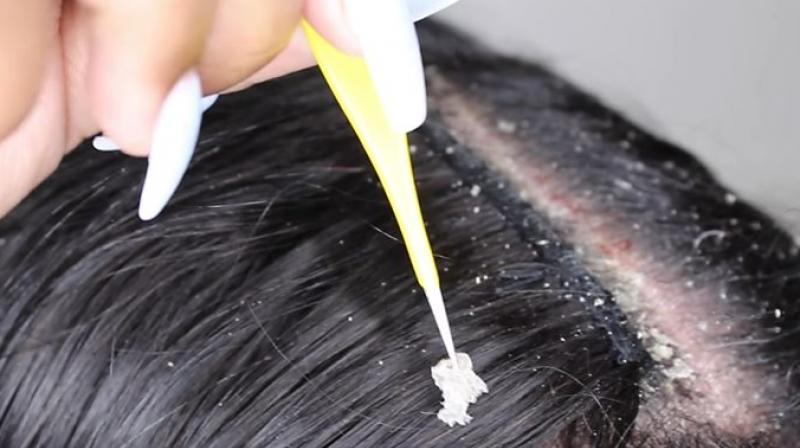 Dandruff Dandruff