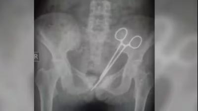 Scissors lying in the woman's stomach for 12 years