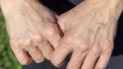 Visible veins on body can cause major problems