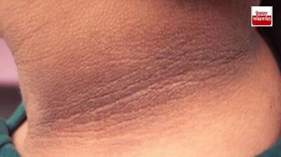 If your neck has turned black then try this recipe