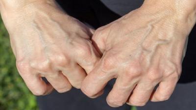 Appearance of veins in body