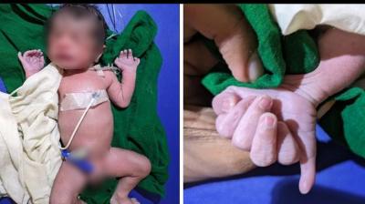 baby boy born 25 fingers  