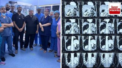 Delhi: World's largest adrenal tumor removed through robotic surgery at Safdarjung Hospital