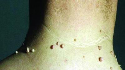 People suffering from the problem of moles can get relief with these home remedies Health News