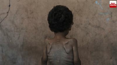 55,000 young children in Gaza suffer from severe malnutrition UN News