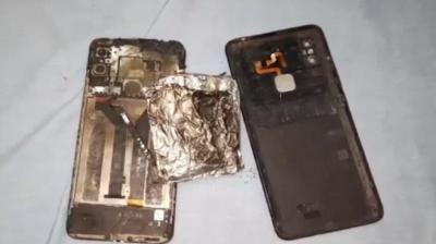 Mobile phone exploded while playing video game: 13-year-old boy suffered severe burns on his stomach, hands and face