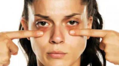  If the circles of your eyes have become dark, then follow these 4 tips