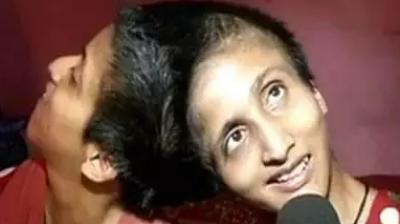 Patna conjoined twins individual voting rights