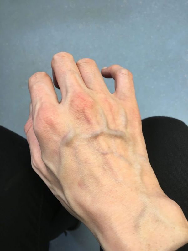 Visible veins on the body can cause major problems Visible veins on the body can cause major problems