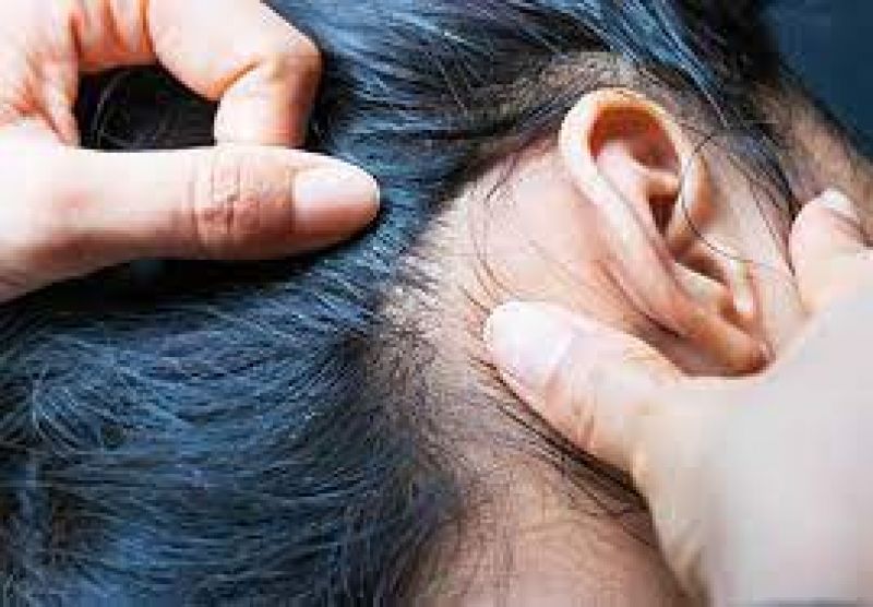 lice lice lice lice lice lice