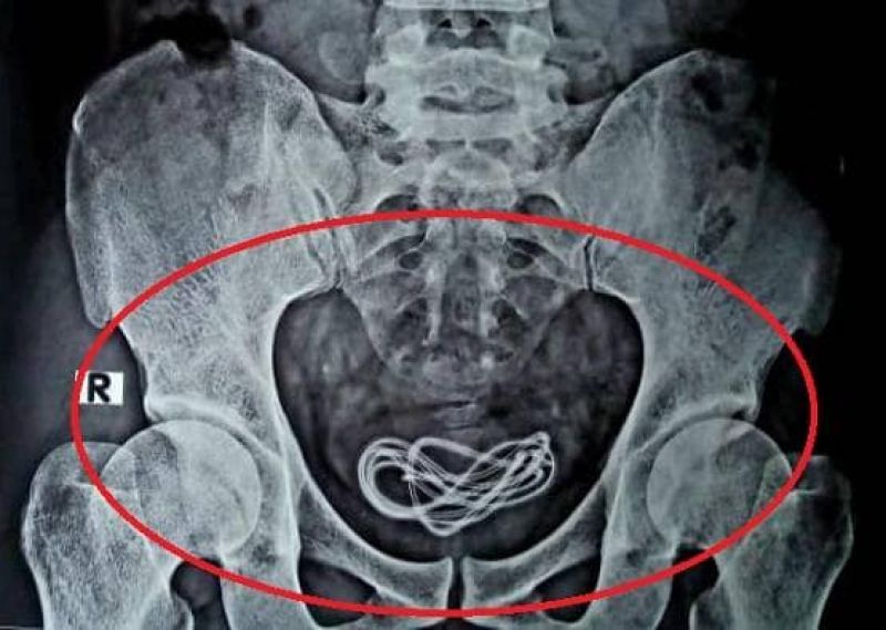 Mobile phone charger removed from bladder