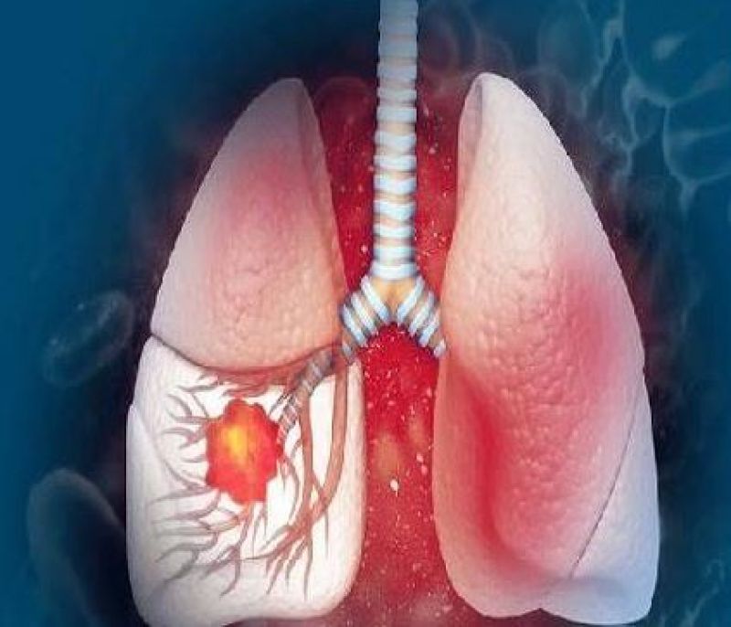 Lung Cancer, Stage-3