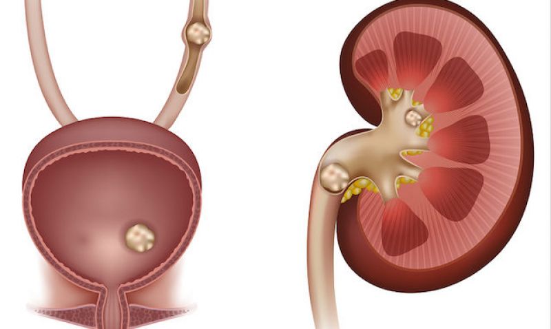 Wrong Life-style causes stones in the human body Wrong Life-style causes stones in the human body