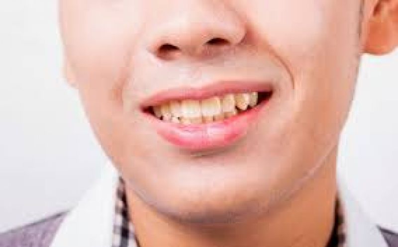 Follow these home remedies to get rid of yellow teeth