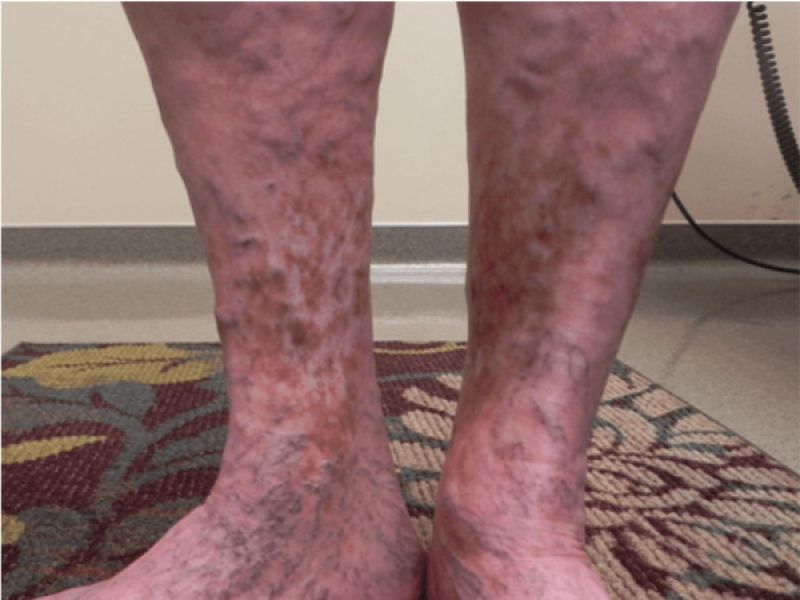 Appearance of veins in body