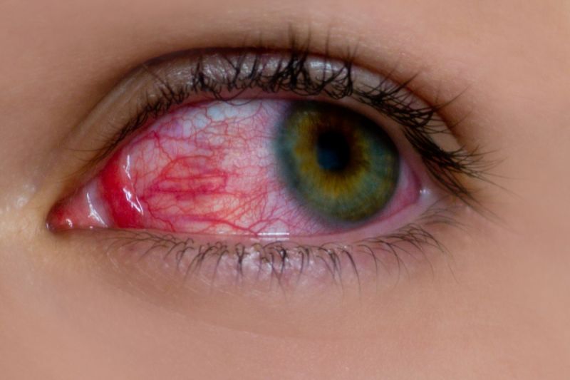 Pink eyes may be the primary symptom of covid-19: a study