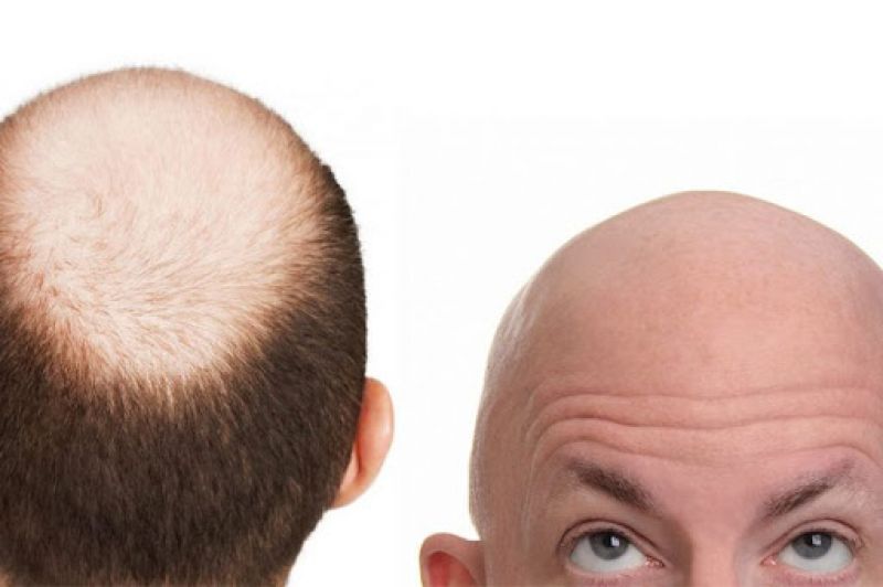 Baldness Baldness
