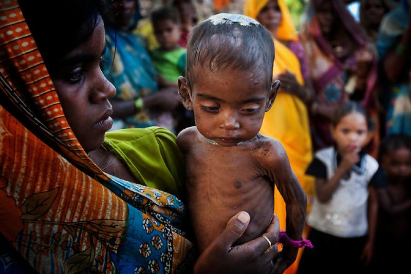 Vitamin D can improve the Malnutrition Vitamin D can improve the Malnutrition