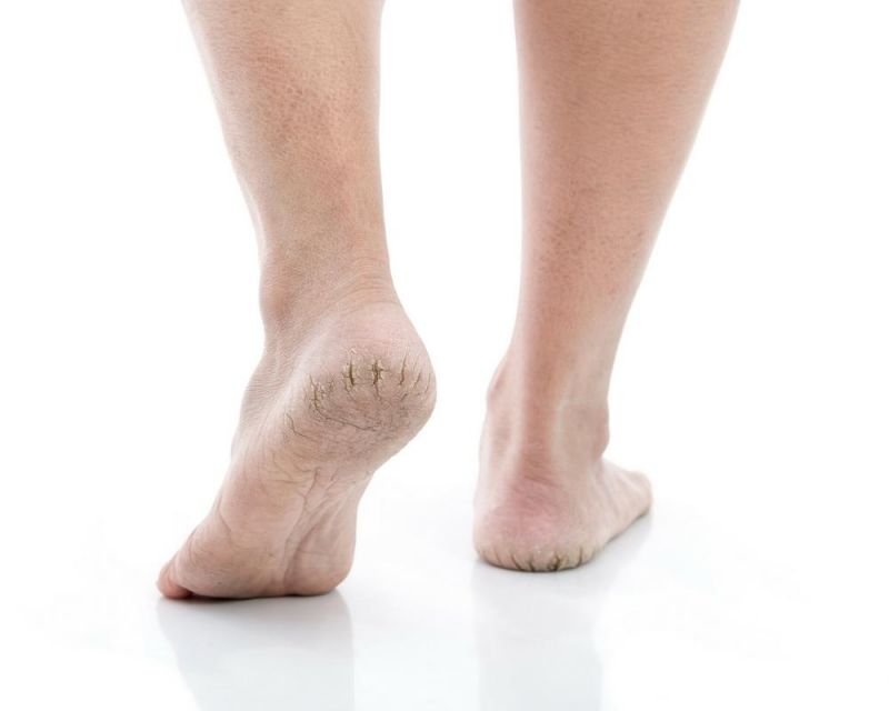 Cracked Heels