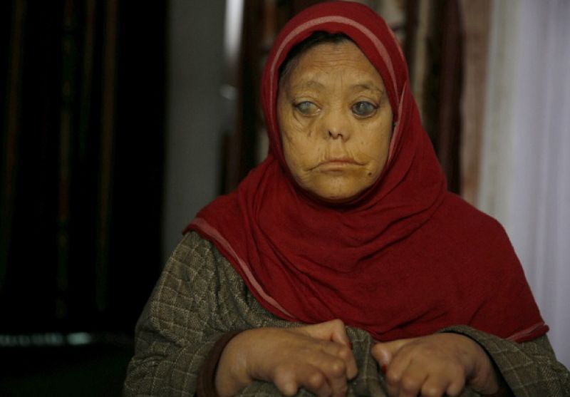 Leprosy effected woman