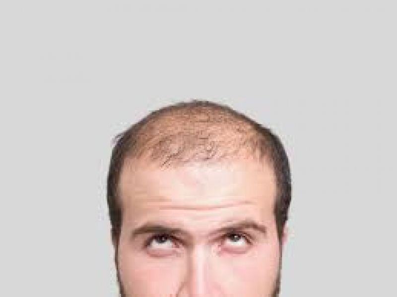 Baldness Baldness