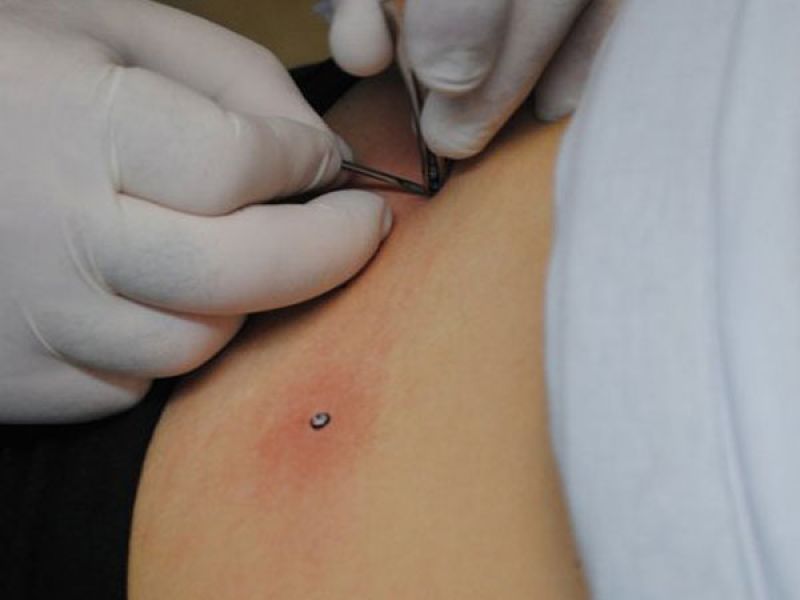 Body piercing 