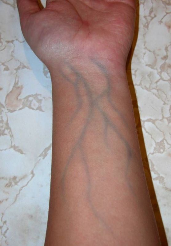 Visible veins on the body can cause major problems Visible veins on the body can cause major problems