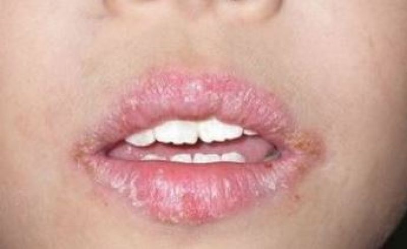 lip Balm might harm