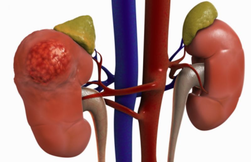 villagers are facing kidney related problems in chhattisgarh villagers are facing kidney related problems in chhattisgarh