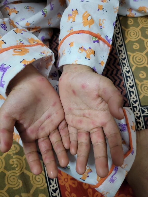 Mohali Civil Surgeon statement on suspected case of Monkeypox Mohali Civil Surgeon statement on suspected case of Monkeypox