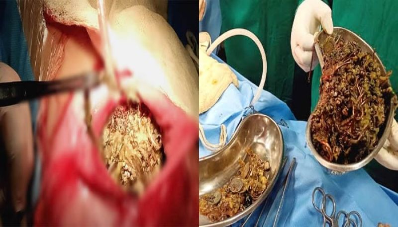 Ornaments in stomach