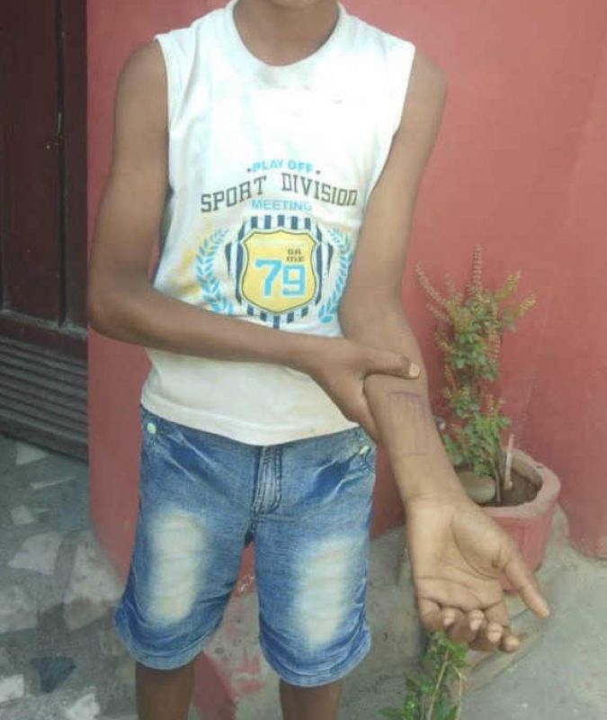 Harshdeep Singh shows stamp on his arm.