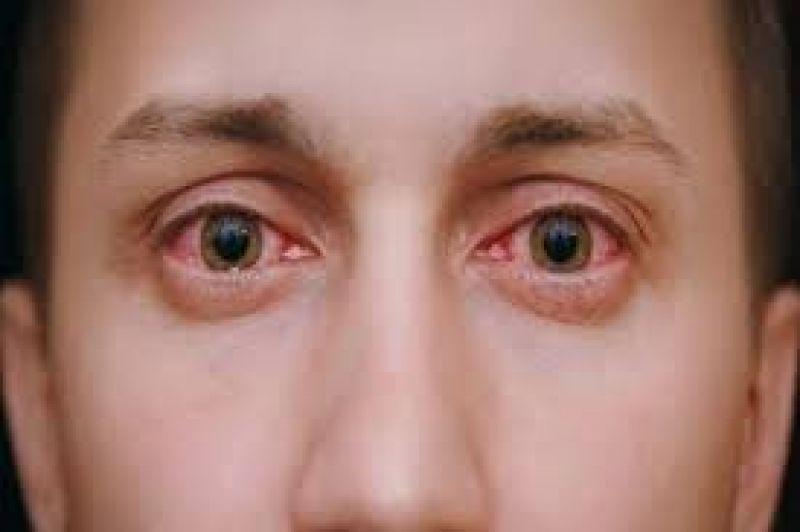 Pink eyes may be the primary symptom of covid-19: a study