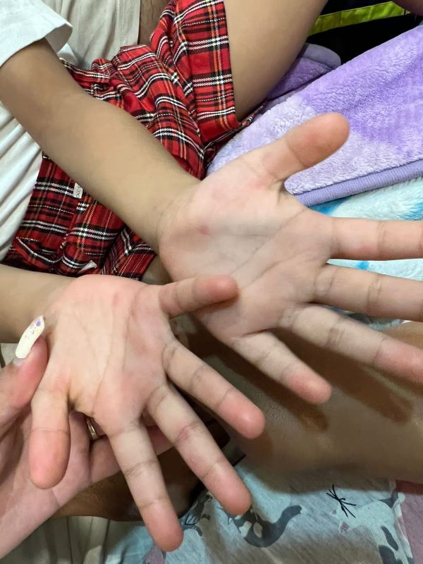 Mohali Civil Surgeon statement on suspected case of Monkeypox Mohali Civil Surgeon statement on suspected case of Monkeypox