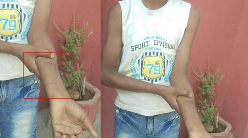 Harshdeep Singh shows stamp on his arm.