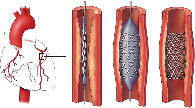 Coronary stent