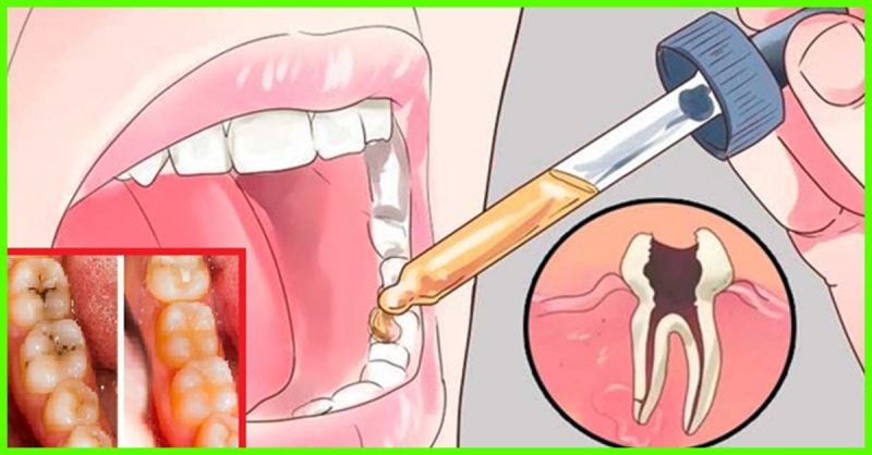 Mustard oil for teeth