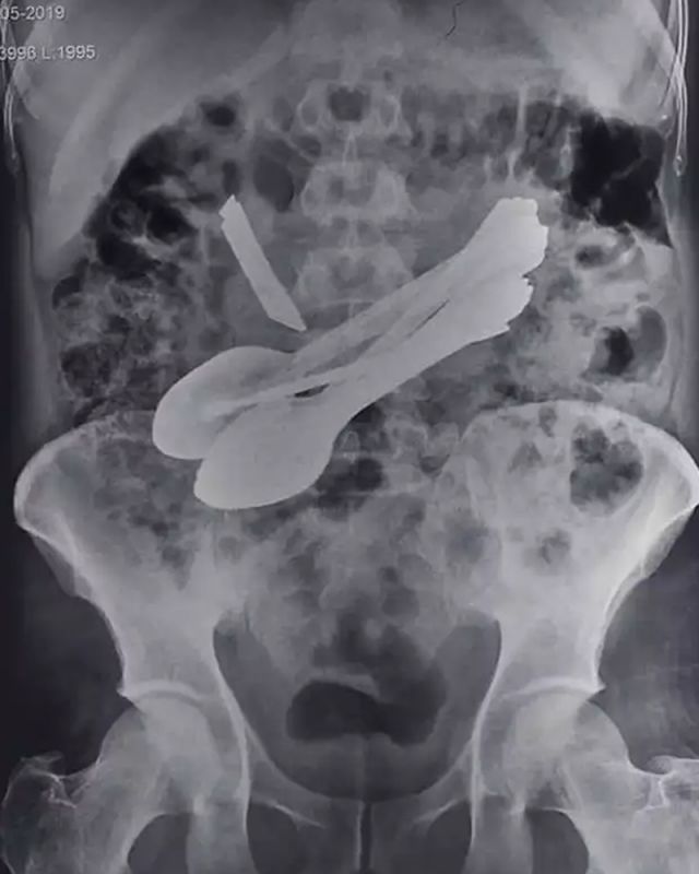 Doctors take out toothbrushes knives spoons etc from man's stomach