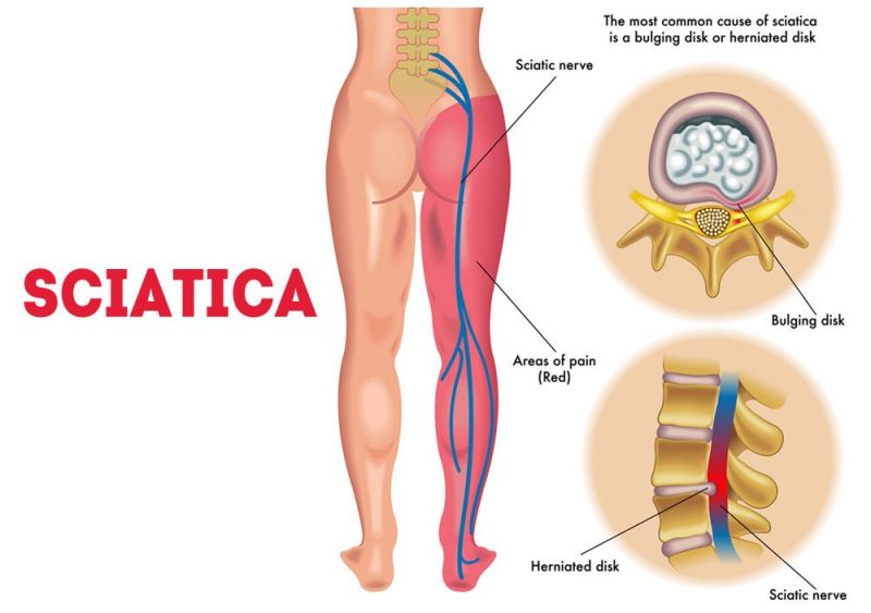 Sciatica Pain 