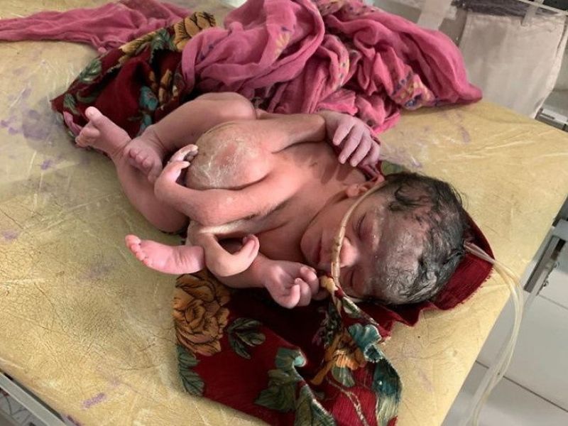 Four legged girl born in Rajasthan