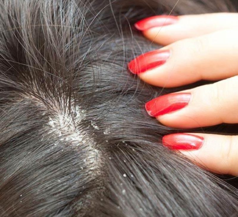 dandruff