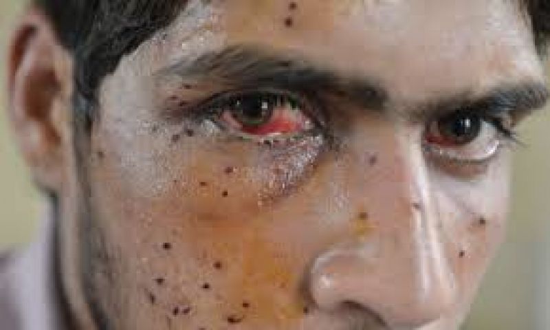 Pellet gun injure face and eyes